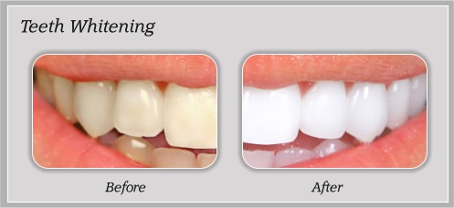 Teeth Whitening