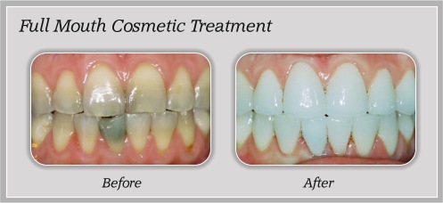 Full Mouth Cosmetic Treatment