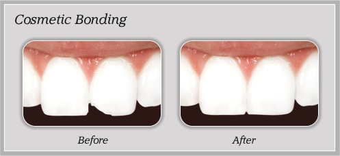 Cosmetic Bonding