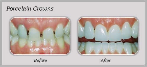 Porcelain Crowns