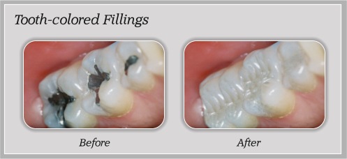 Tooth Colored Fillings